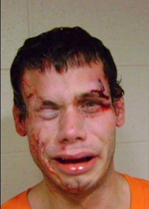 Figure 3 : Colin, un détenu. Photo d'un homme au visage ensanglanté présentant des plaies.